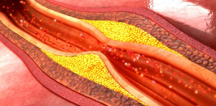 arterias tapadas con colesterol