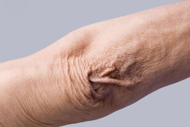 El brazo de una mujer que tiene arrugas y necesitaría usar colágeno hidrolizado para hacer su piel más elástica