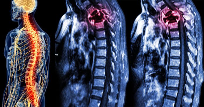 6 signos de lesión en la espalda que no debes ignorar