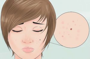 5 remedios naturales para combatir brotes de acné y tratar las cicatrices