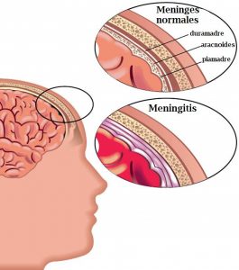 meningitis cerebro