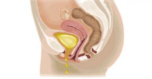 incontinencia urinaria ilustración