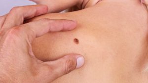 Que es el melanoma: causas y síntomas